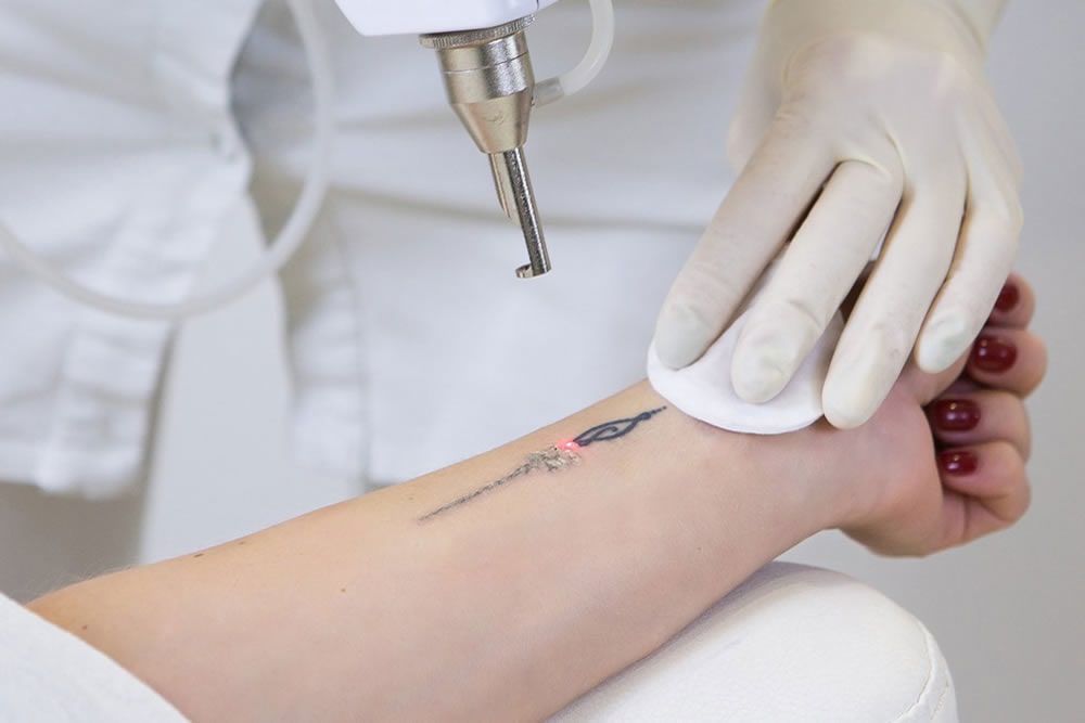 Laser para remoção de Tatuagens